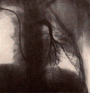  Así fue cómo se logró, la primer radiografía de corazón en toda la historia, tal como se la ve