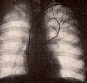 Las radiografias salieron todas tal como estaba planeado e incluso se registró gran parte de la circulación pulmonar.